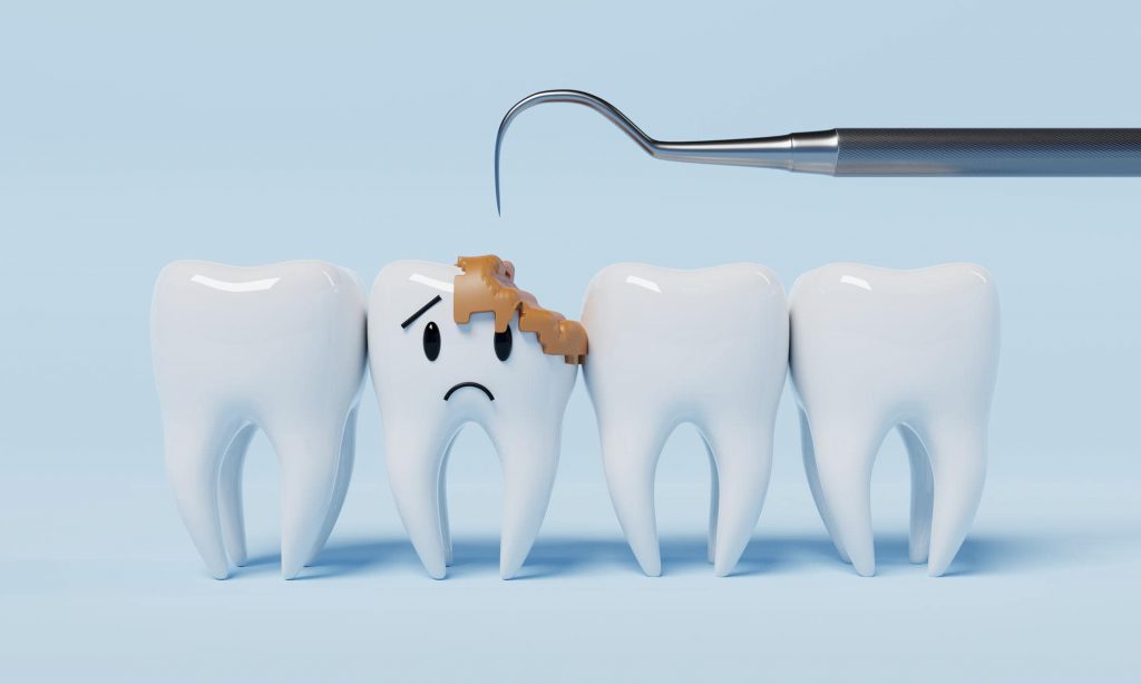 Sâu răng là gì?