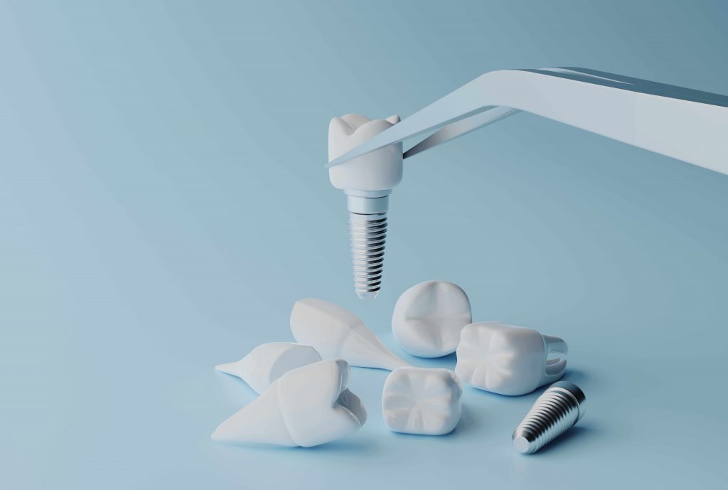trồng răng implant mất bao lâu